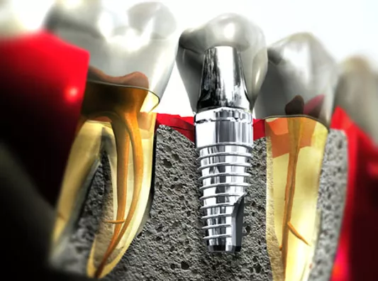 Implantes dentários