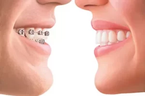Ortodontia Aparelho Dentário