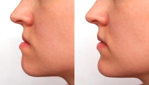 Preparo Ortodôntico para Cirurgia Ortognática