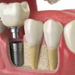 implantes dentários belem