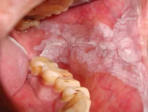 tumores da boca 