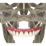 Implantes zigomaticos 04