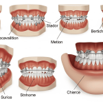 7 Tipos de Aparelho Ortodôntico Infantil – Instituto INCOM Tipos de Aparelho Ortodontico Infantil