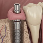 Implante Dentario Preco 2026 Belem