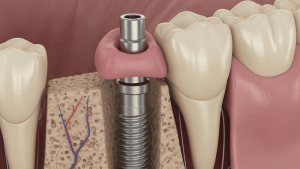 Implante Dentário Preço 2026 Belém Implante Dentário Preço 2026 Belém