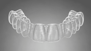 Invisalign Antes e Depois - Instituto INCOM