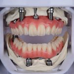 Protese Protocolo no Instituto INCOM