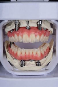 Prótese Protocolo no Instituto INCOM