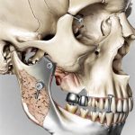 Reconstrução Óssea do Maxilar: 4 Etapas do Tratamento Explicadas Reconstrucoes Osseas dos Maxilares