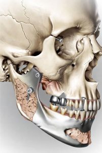 reconstrução óssea do maxilar