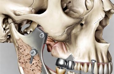 Reconstruções Ósseas dos Maxilares