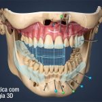 Cirurgia Ortognatica com Tecnologia 3D