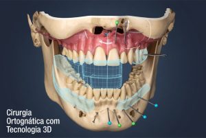 Cirurgia Ortognática com Tecnologia 3D