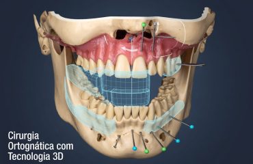 Cirurgia Ortognática com Tecnologia 3D