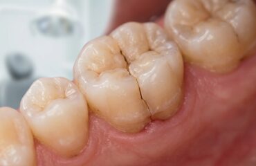 Dente Trincado