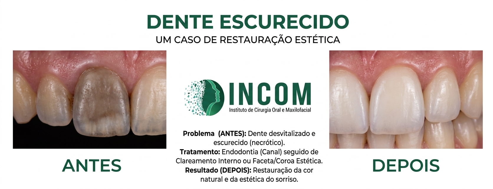 Dente Escurecido